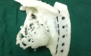 3D科技肩 深圳：首次运用3D打印技术为患者换“肩”